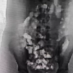 Adolescente tenta entrar em presídio com 32 porções de droga no corpo em SC | CNN Brasil