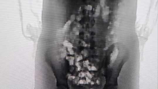 Adolescente tenta entrar em presídio com 32 porções de droga no corpo em SC | CNN Brasil